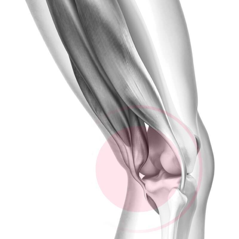 Rappresentazione schematica Dolore nella parte posteriore del ginocchio